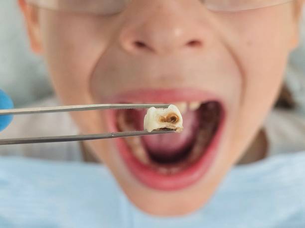 Best Broken or Cracked Tooth Emergency Dentist in Del Norte, CO